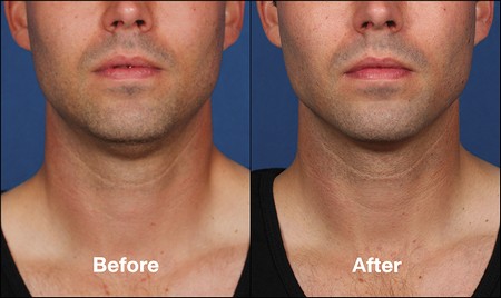 Kybella before and after male