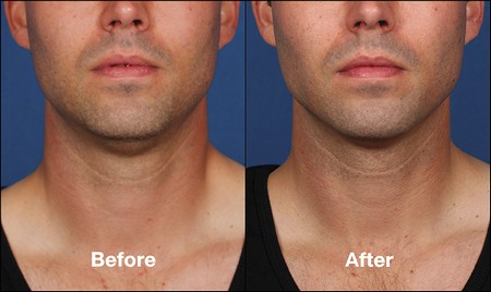 Kybella before and after male