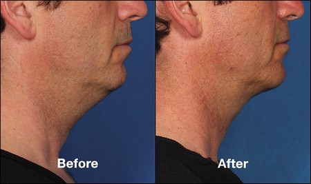 Kybella before and after male side profile view