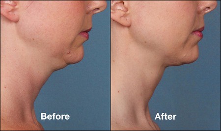 Kybella before and after woman side profile view