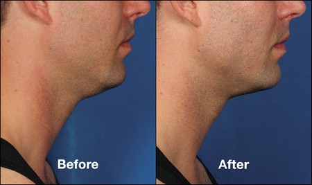 Kybella before and after male side profile view
