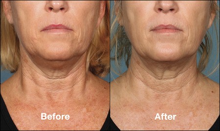 Kybella before and after middle age woman