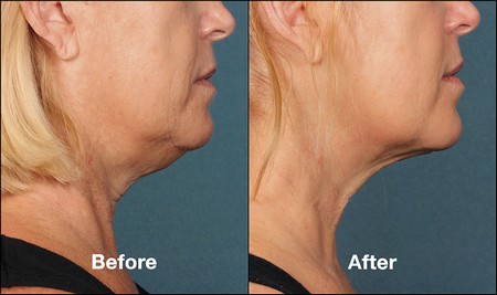 Kybella before and after woman side profile view