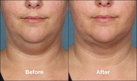 Kybella before and after