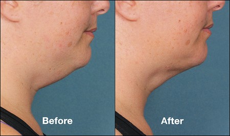 Kybella before and after side profile view