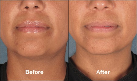 Kybella before and after