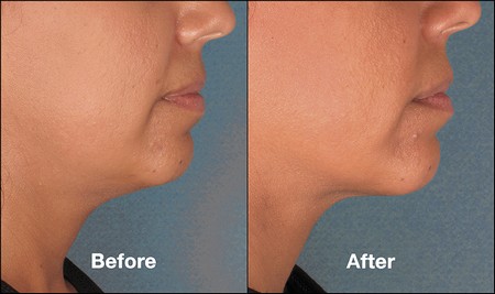 Kybella before and after side profile view