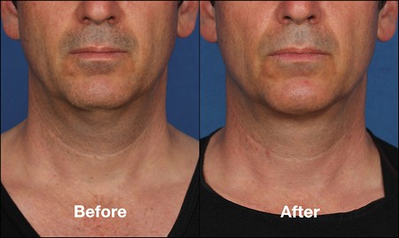 Kybella before and after middle age male