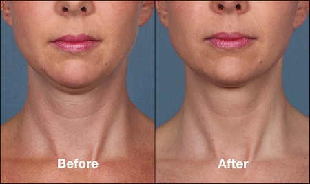 Kybella before and after woman