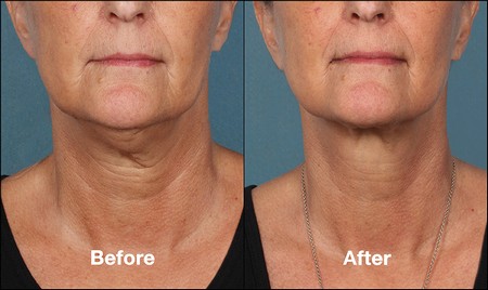 Kybella before and after, middle aged female neck