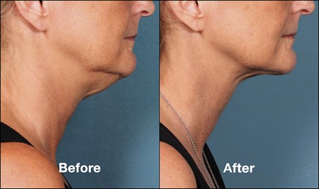 Kybella before and after profile view