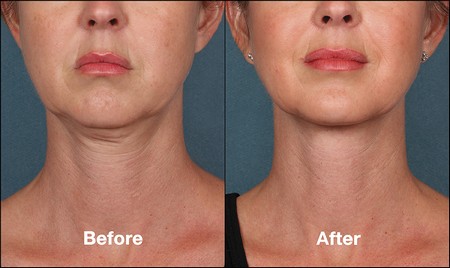 Kybella before and after