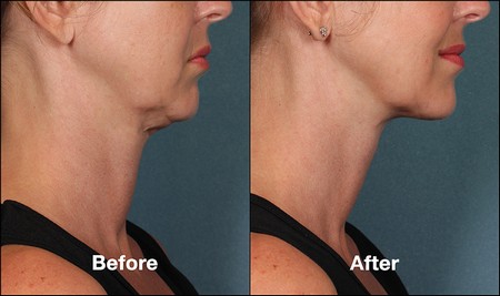 Kybella before and after side profile
